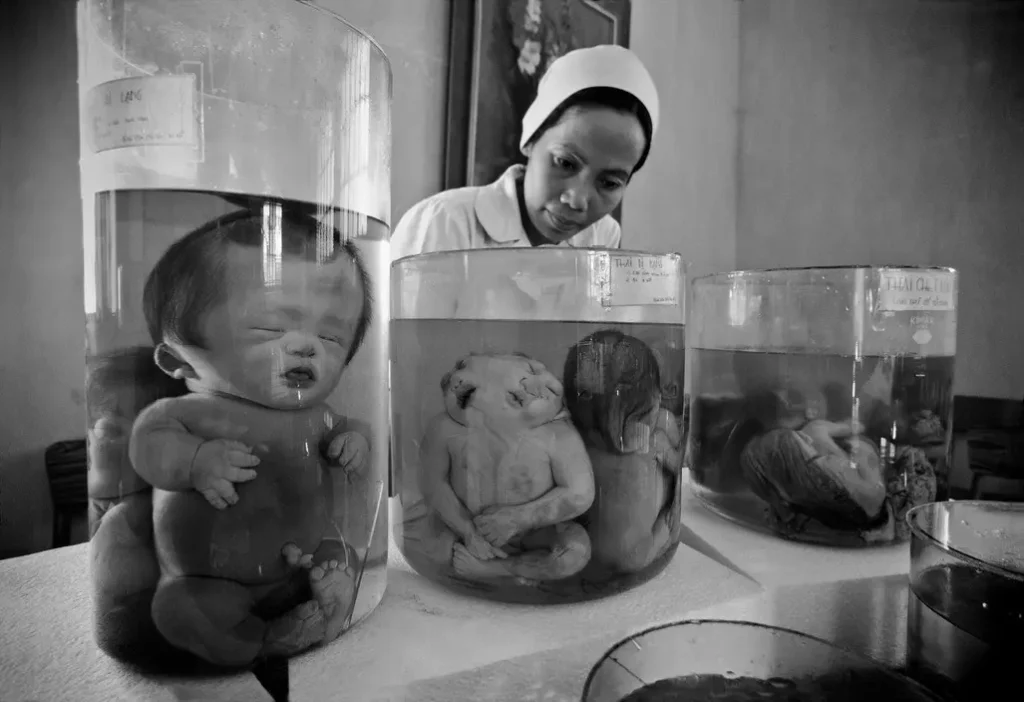 bayi yang terdampak agent orange